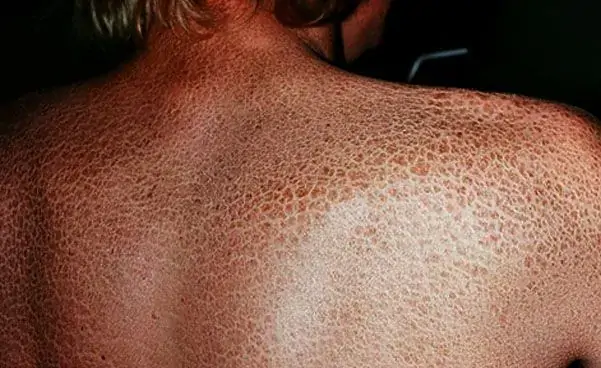 Balık Pulu Hastalığı